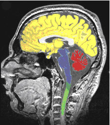 MRI Scan